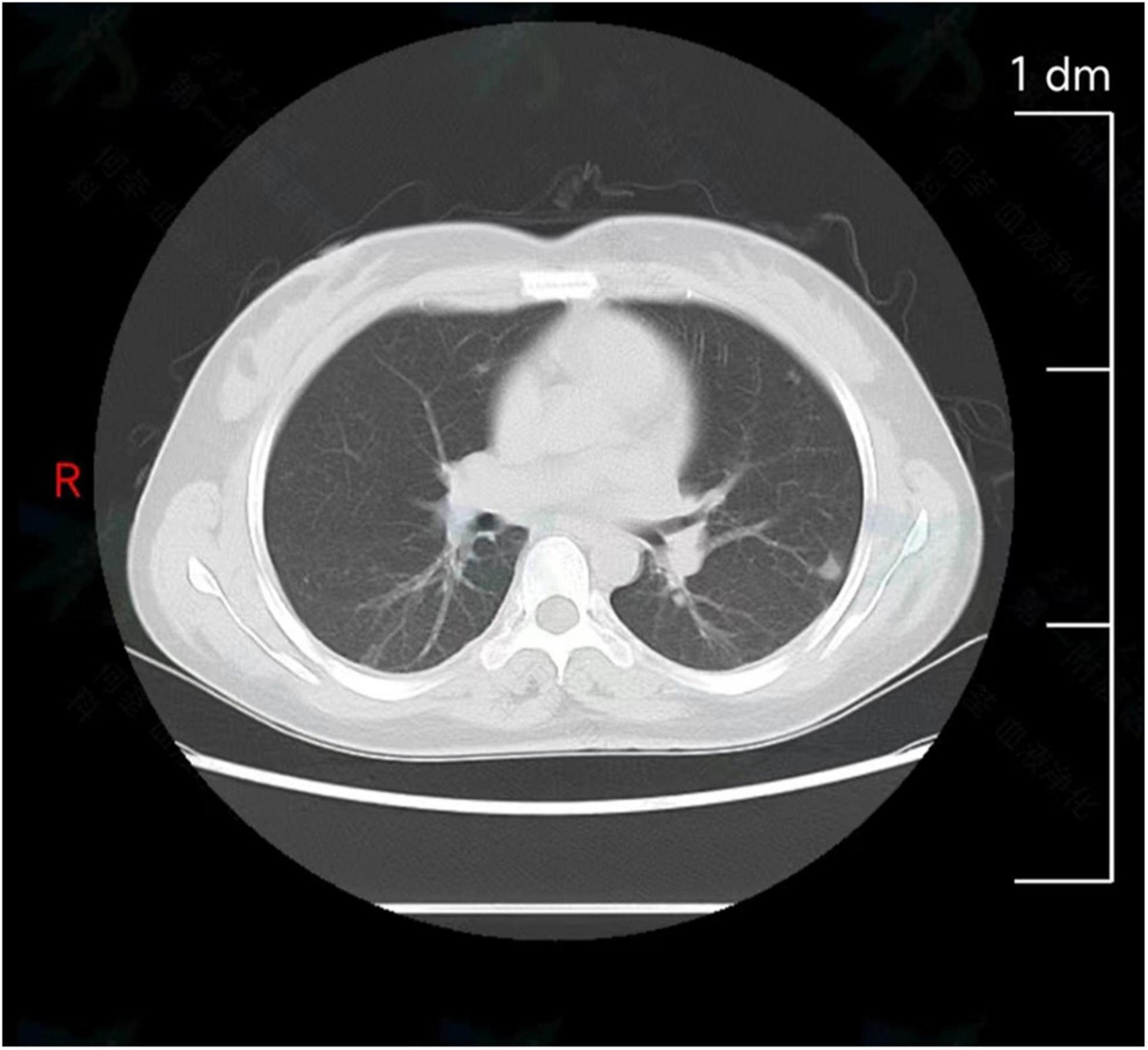 Case report: Brucellosis with rare multiple pulmonary nodules in a depressed patient